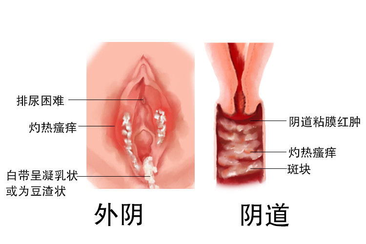 假丝酵母菌感染图