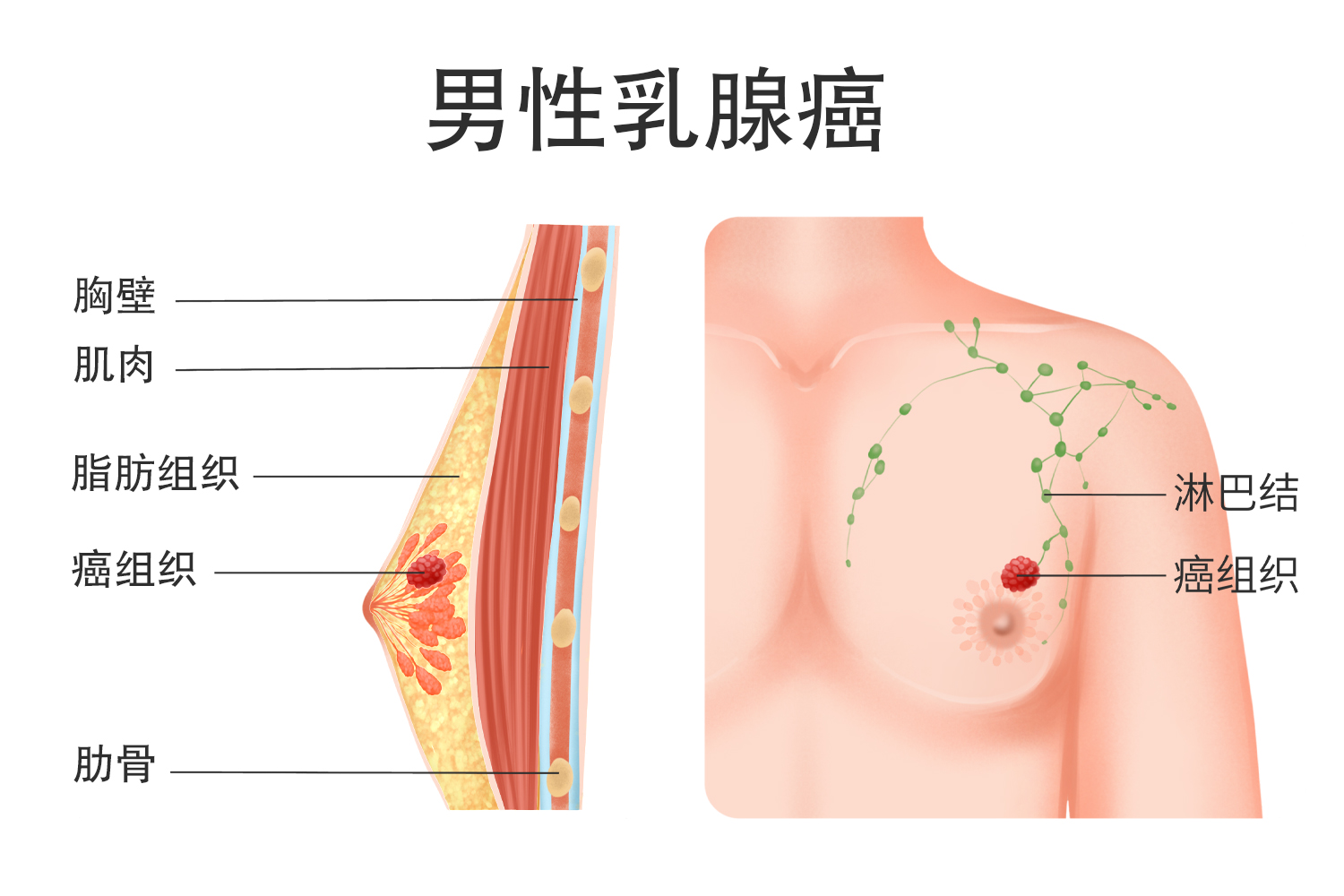 男性乳腺癌图