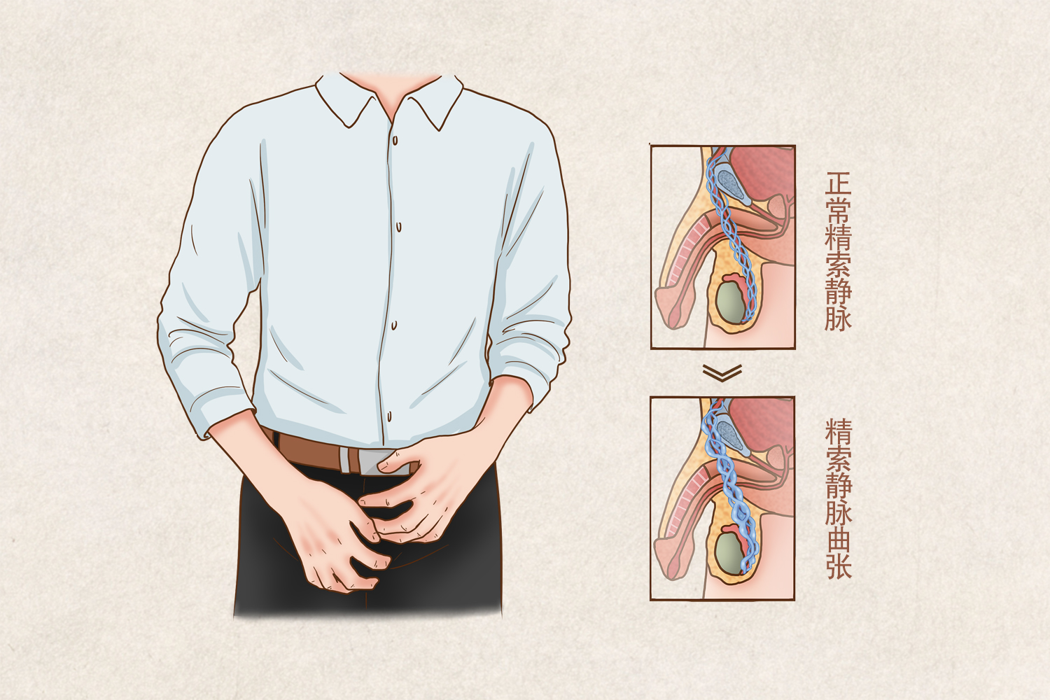 精索静脉曲张图