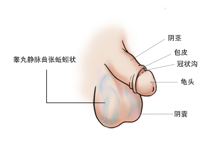 精索静脉曲张图