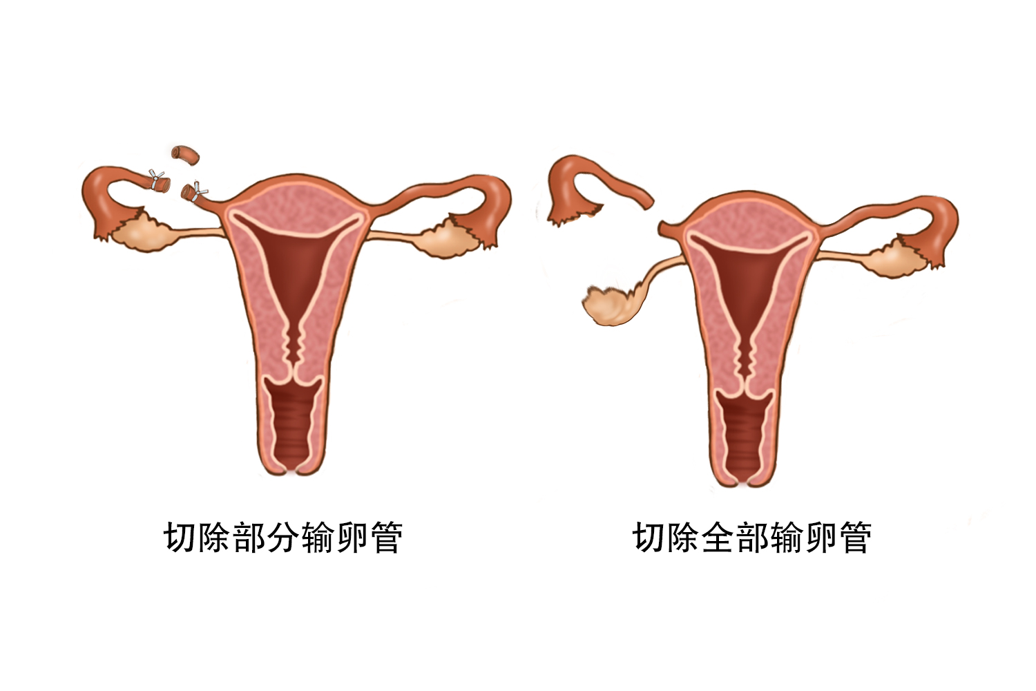 输卵管切除
