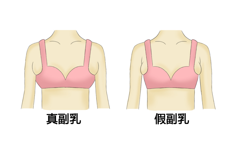 真假副乳区别图