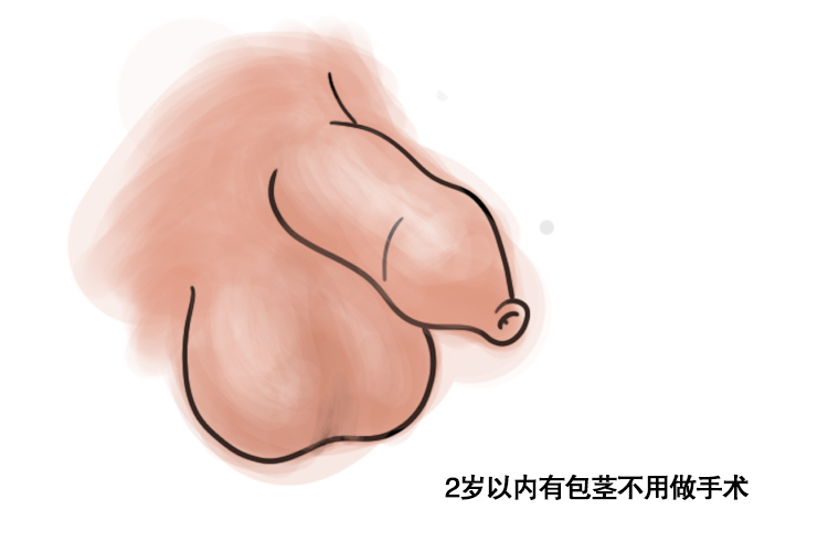 男性包茎图