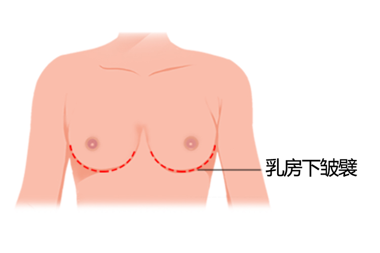 乳房下皱襞图