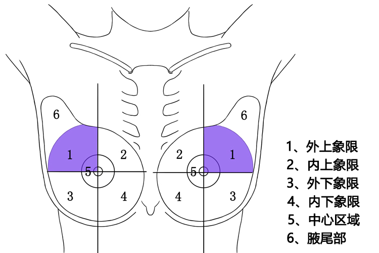 乳腺癌常见部位图
