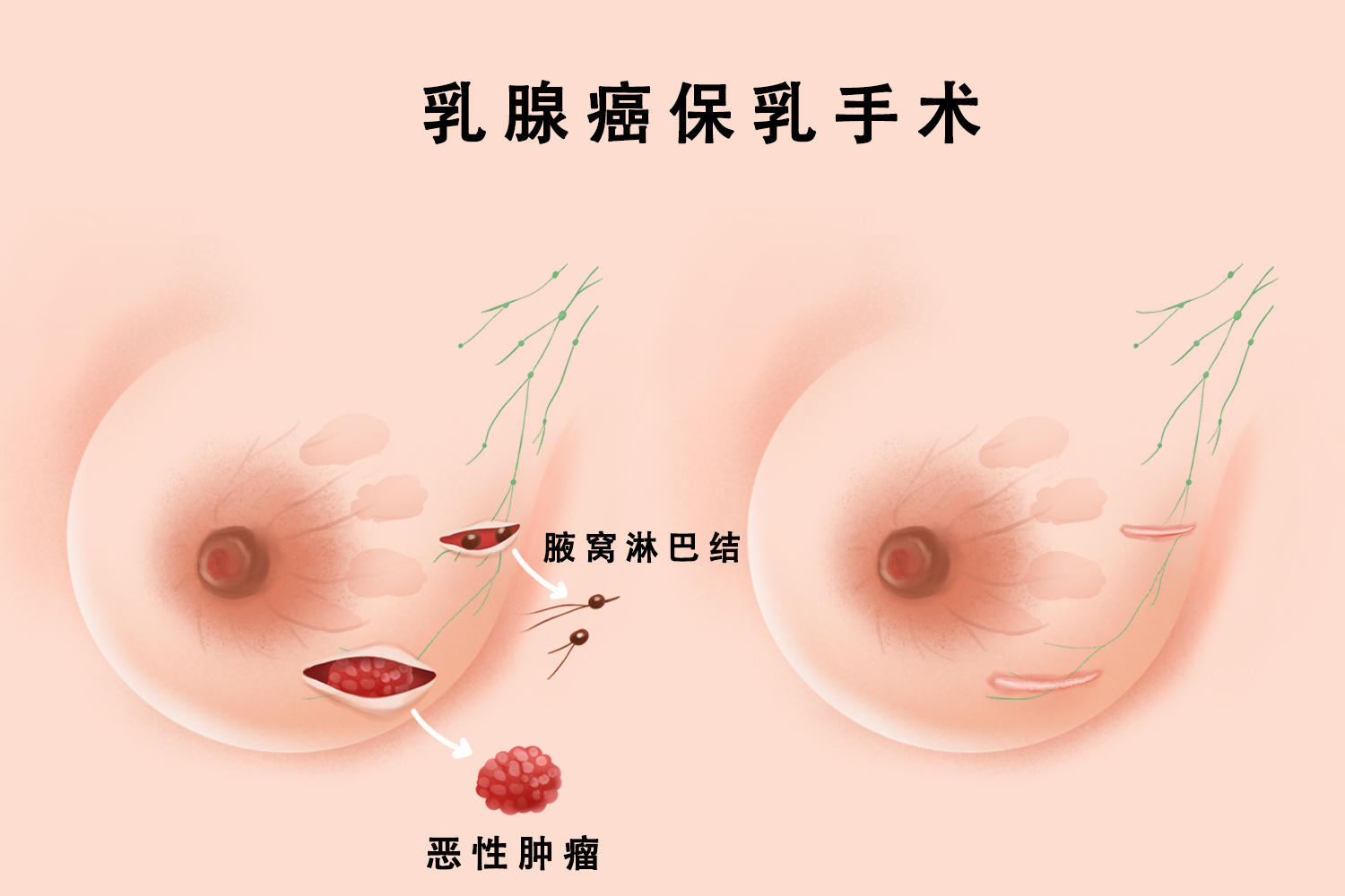 乳腺手术图